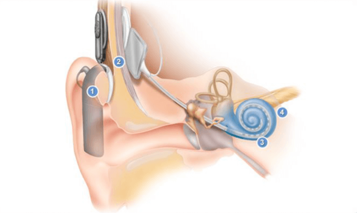 Inner ear demonstration and placement of cochlear implant